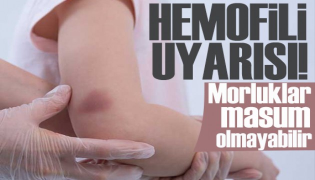 Çocuklarda morluk ve kanama uyarı sinyali olabilir!