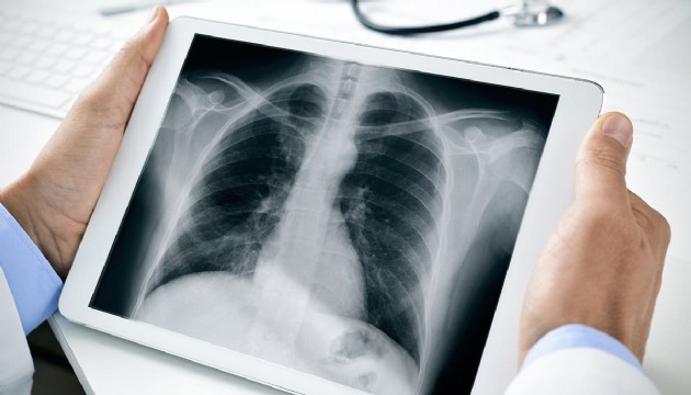 Çarpıcı araştırma: Kanserden ölümlerin 5'te 1'i akciğer kaynaklı
