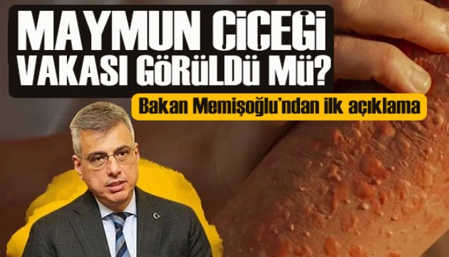 Bakan Memişoğlu'ndan yeni açıklama: Maymun çiçeği vakası görüldü mü?