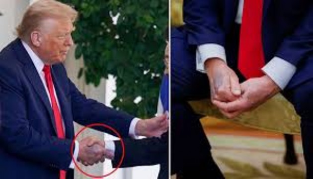 Trump'ın elindeki morluk dikkat çekti