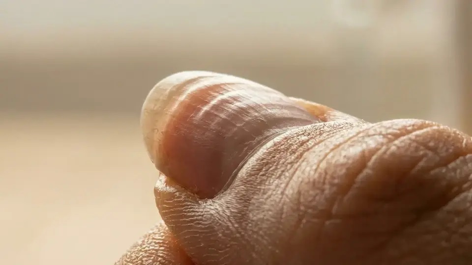 Uzmanlar uyarıyor: Dalgalı tırnak vücudun alarmı