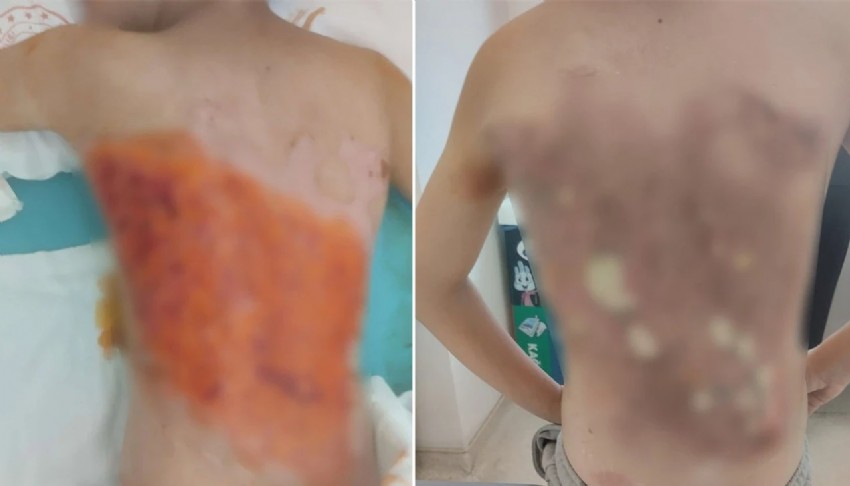 12 yaşındaki çocuğa kolonyalı akran zorbalığı dehşeti