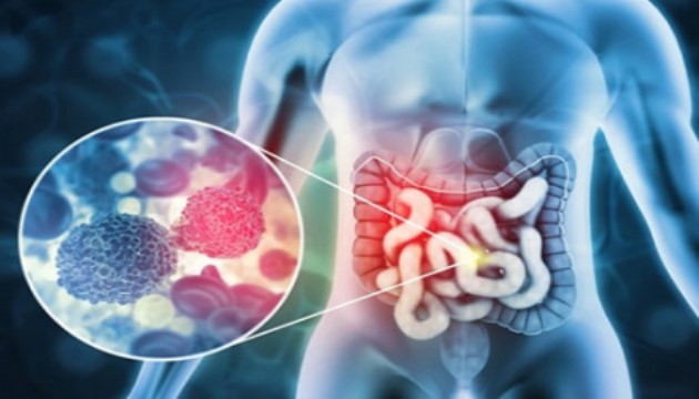 Koleraktal kanserler Türkiye'de en sık görülen üçüncü kanser