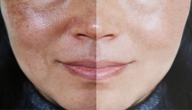 Her leke aynı değil, ciltteki izler ne anlatıyor?