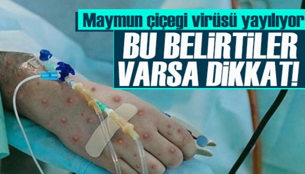 Dünya alarma geçti! Bu şikayetler 'maymun çiçeği' belirtisi olabilir